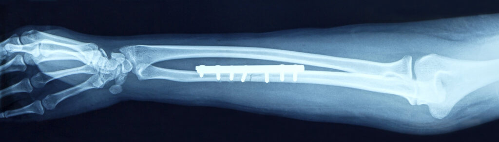  fracture shaft of arm