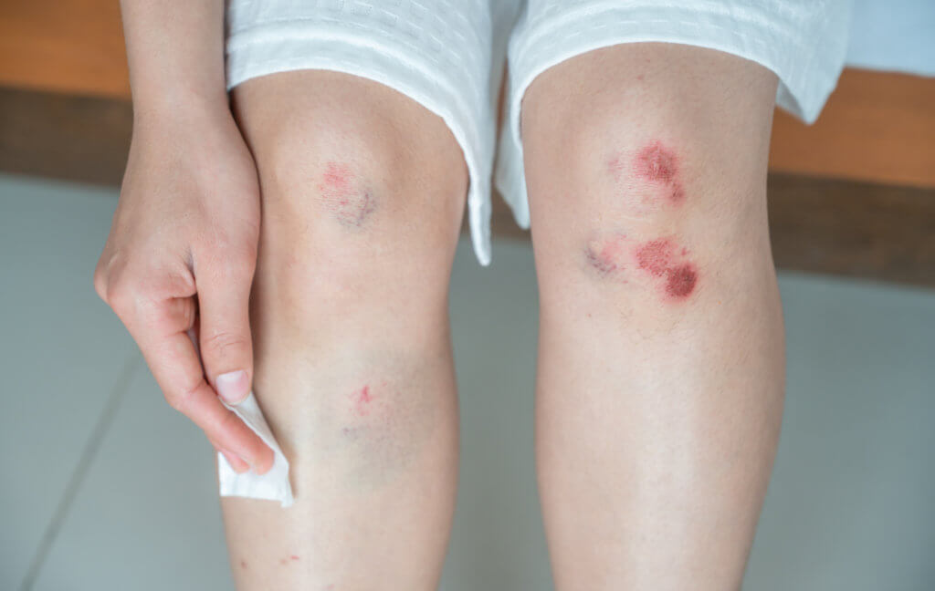 Recovery from a Knee Injury after a Car Accident - Whiplash