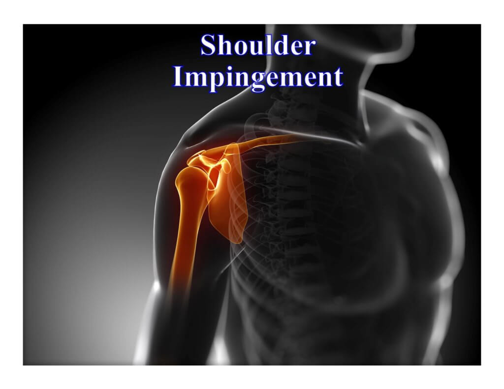 shoulder impingement
