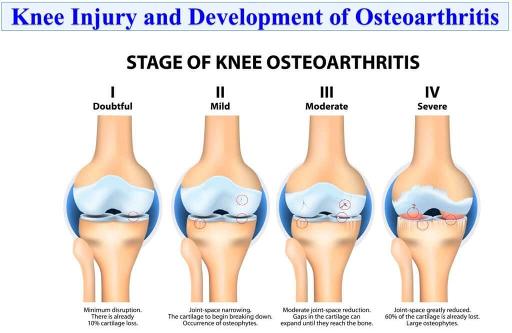 Knee Injury and Arthritis 