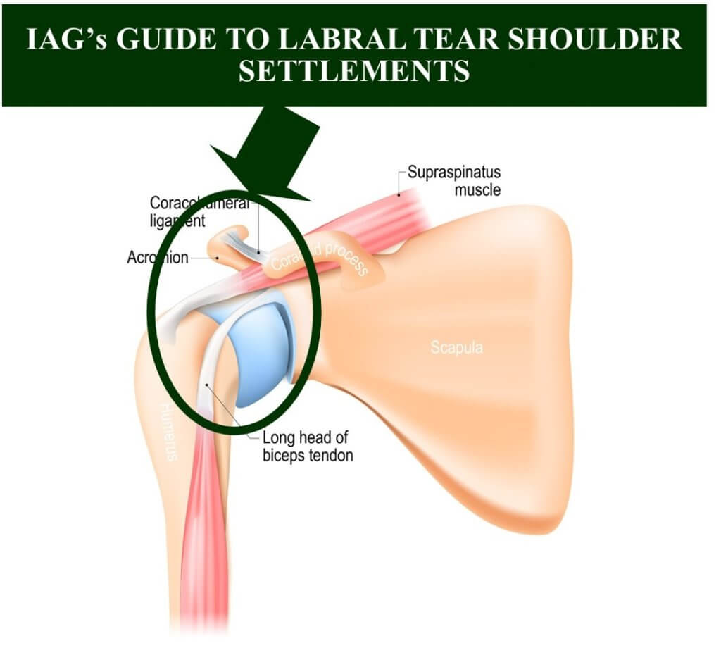 labral-tear-shoulder-settlement-guide-2022-update