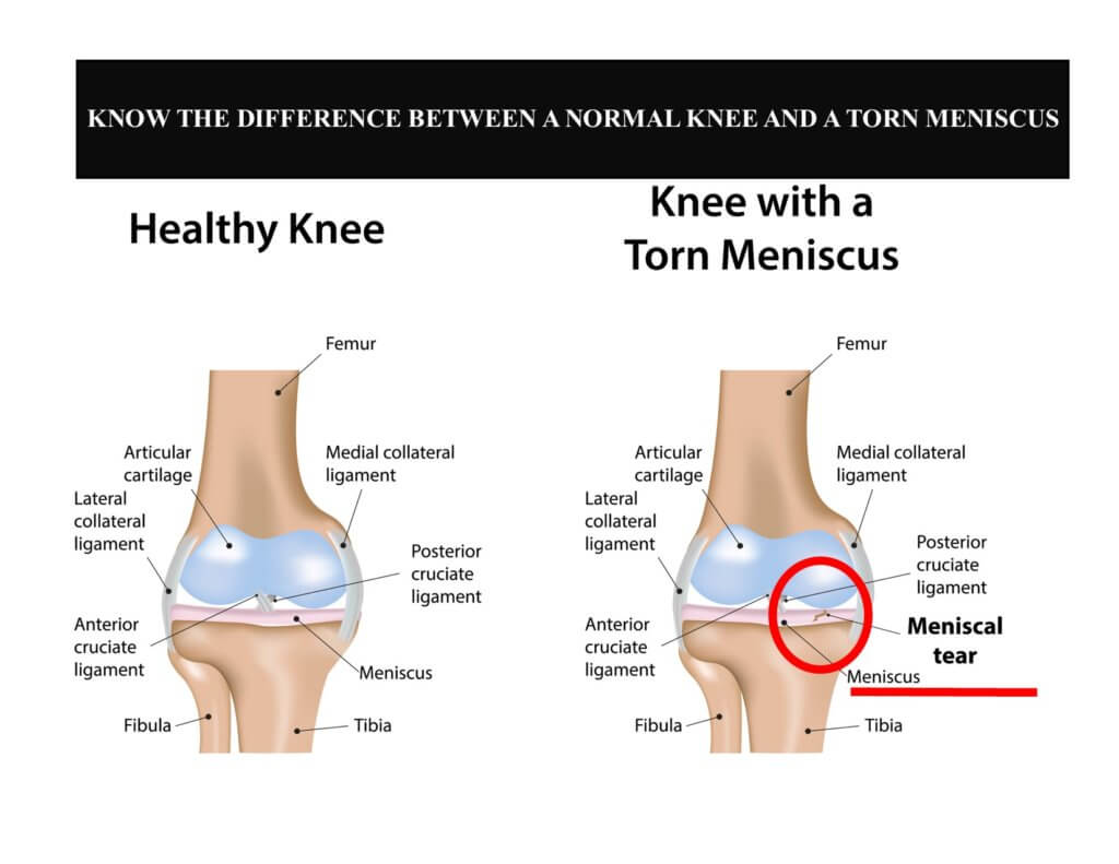 meniscus settlement diagrams