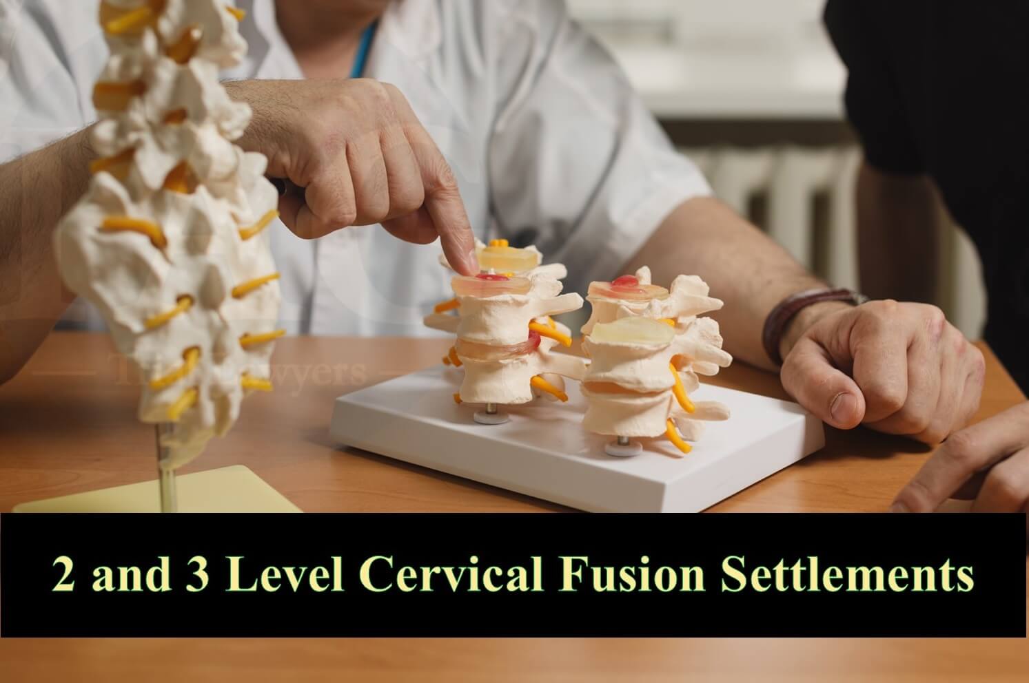3 level cervical fusion settlement