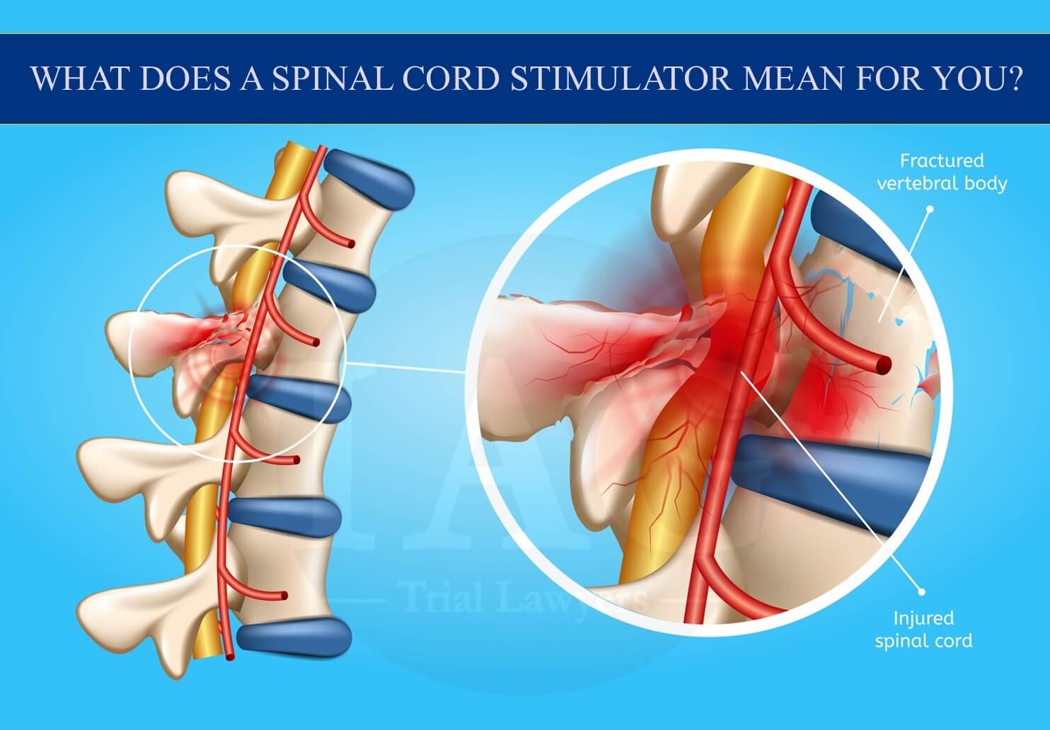 Spinal Cord Stimulator settlement 