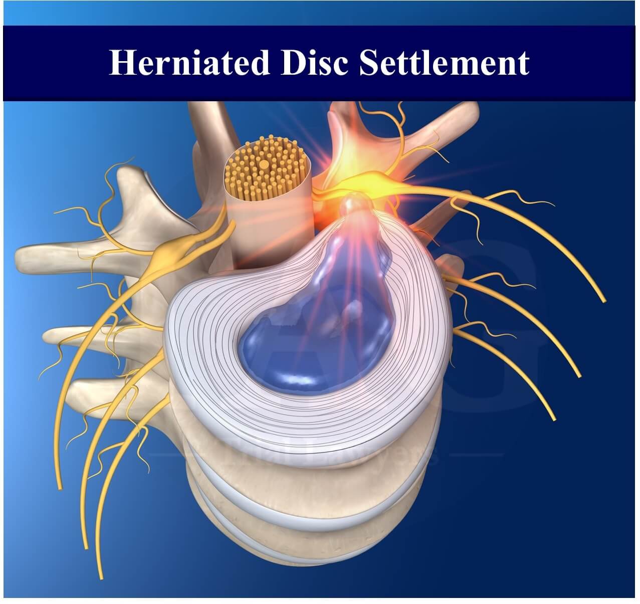 Herniated Disc Settlement.docx