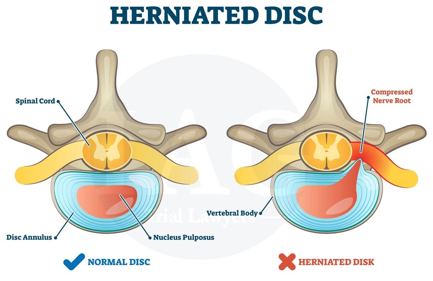 Herniated Disc and Normal Disc