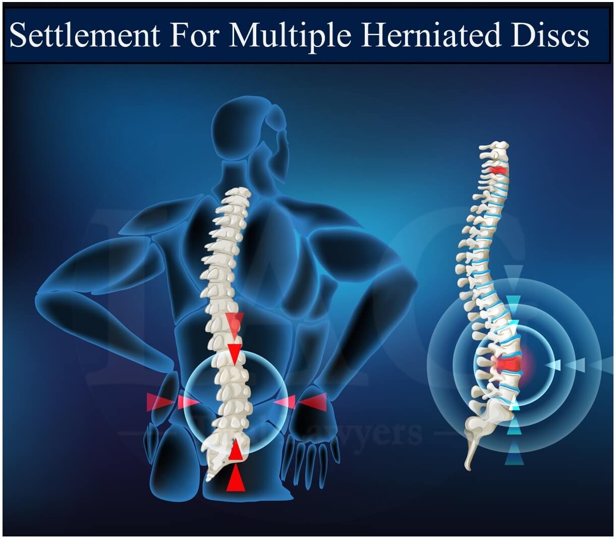 multiple herniated disc Settlement 