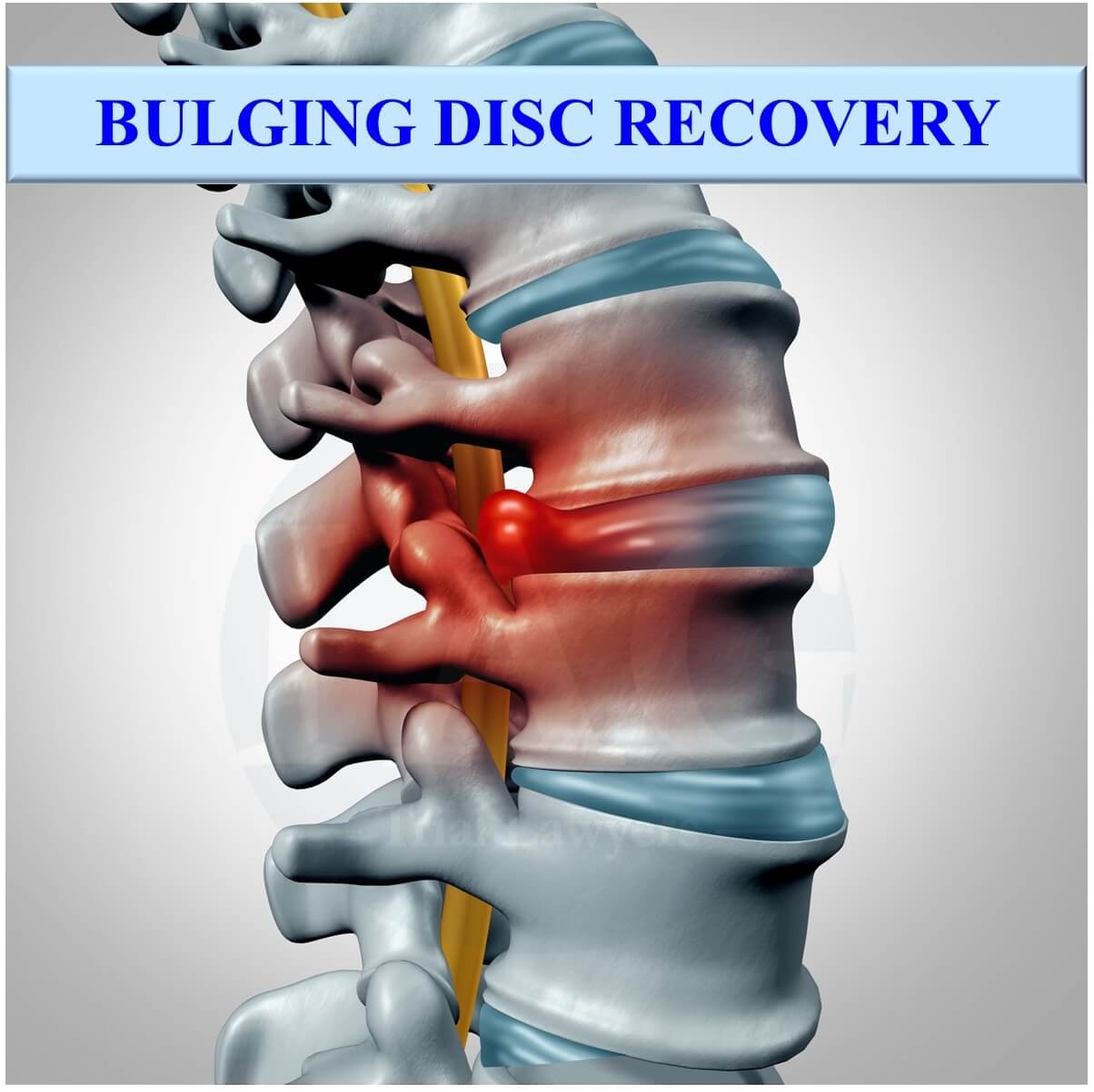 bulging disc recovery