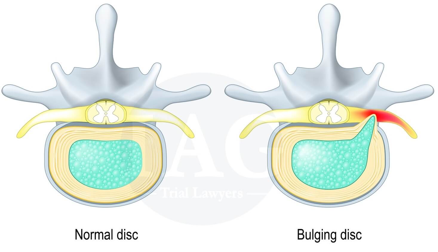 bulging versus normal disc