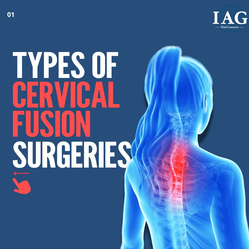 cervical fusion settlements and verdicts