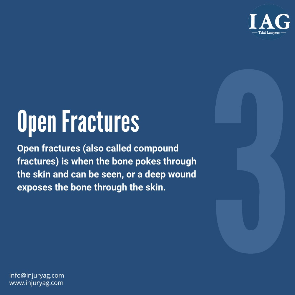 open femur fractures