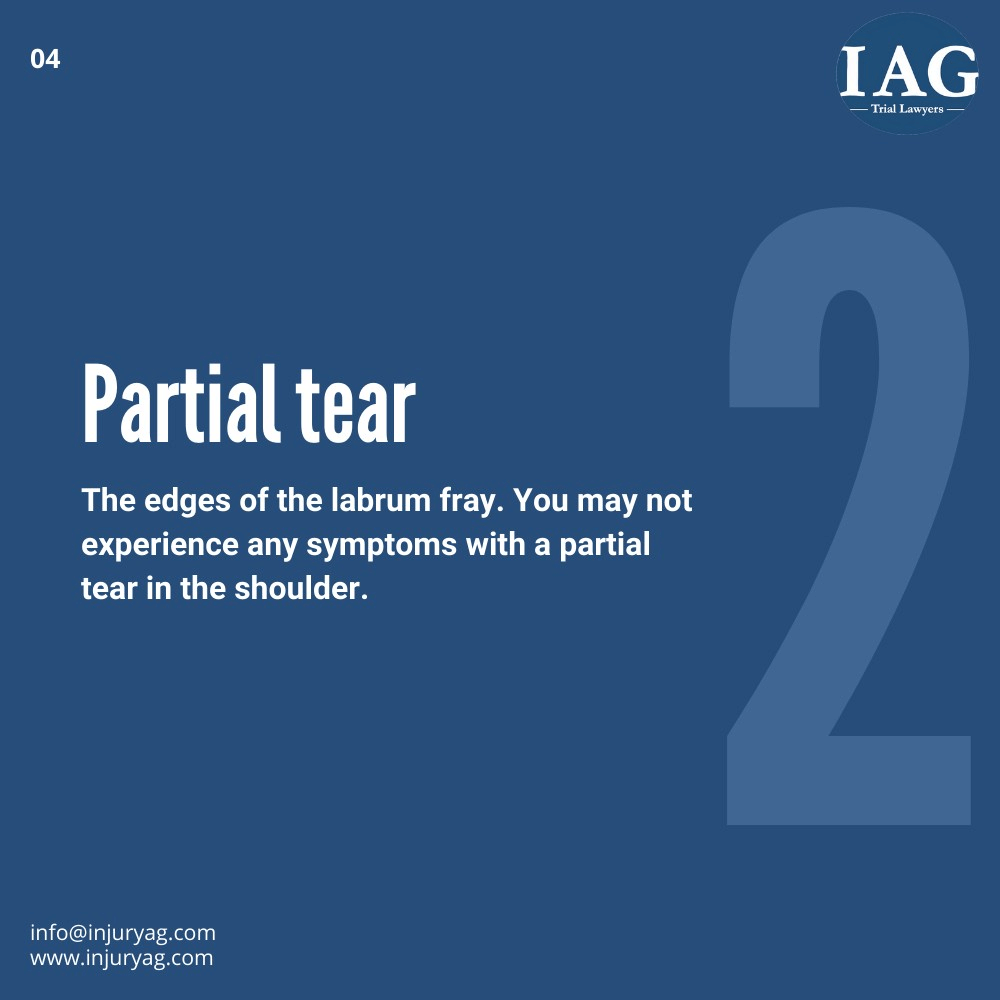 partial labral tear