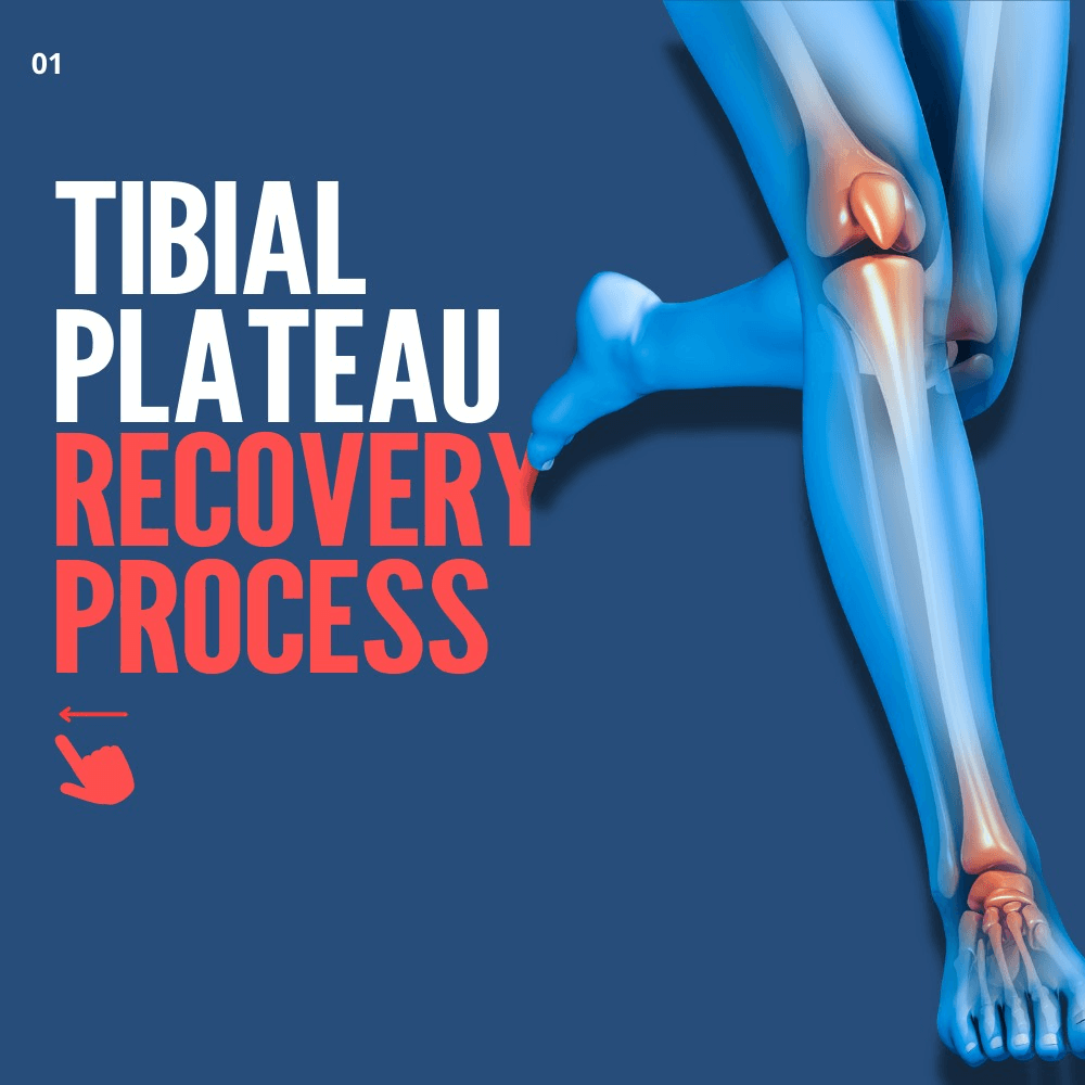 tibial plateau fracture settlement